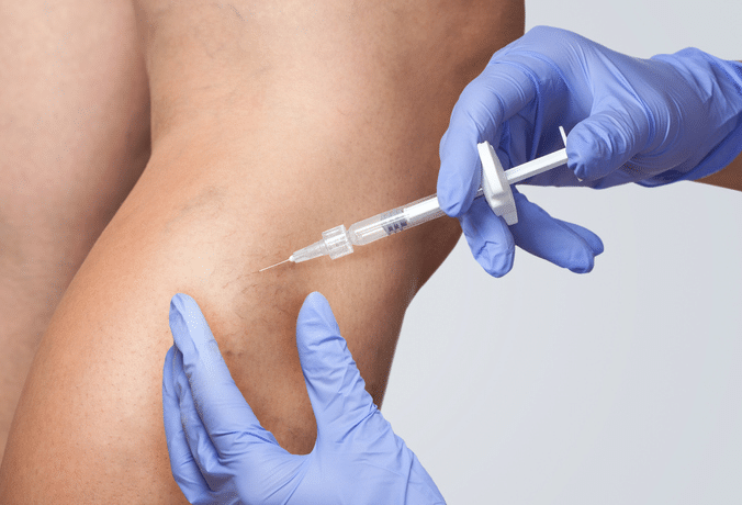 A doctor does medical procedure Sclerotherapy used to eliminate varicose veins and spider veins. An injection of a solution directly into the vein