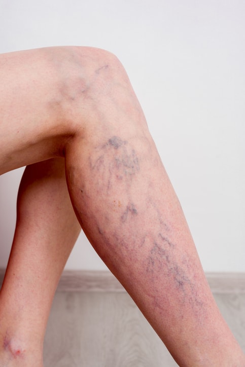 legs with varicose veins on them