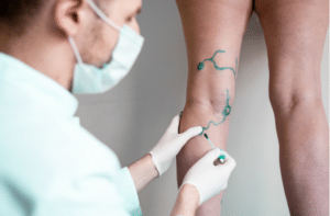 Vascular surgeon is marking veins for varicose surgery.